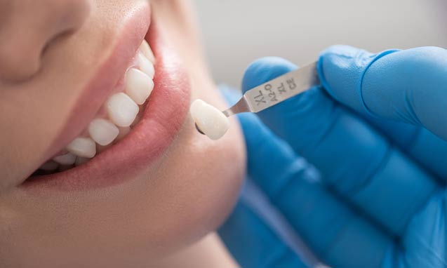 ציפוי לשיניים קדמיות – סוגי הציפויים השונים ותהליך הציפוי