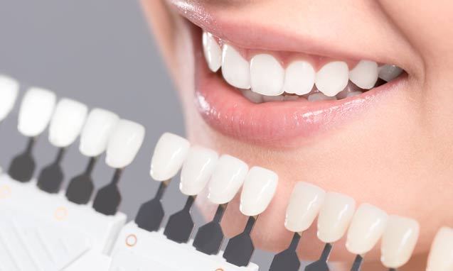 סוגים שונים של ציפוי חרסינה לשיניים